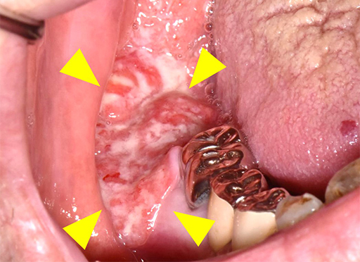 下顎歯肉がん