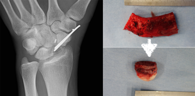 舟状骨偽関節に対する肋骨肋軟骨移植術
