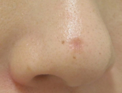 皮膚良性腫瘍（鼻部）：レーザー照射後1か月