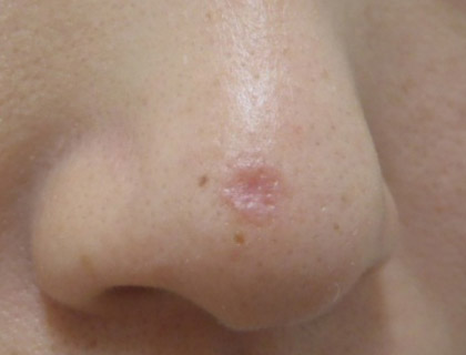 皮膚良性腫瘍（鼻部）：レーザー照射後2週間