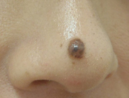 皮膚良性腫瘍（鼻部）：初診時
