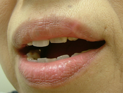 口唇血管腫（静脈湖）：術後1ヶ月