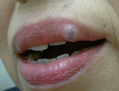 口唇血管腫（静脈湖）：術前