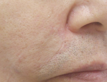頬部皮膚悪性腫瘍：術後3か月