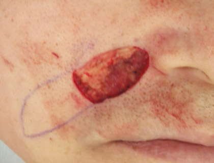 頬部皮膚悪性腫瘍：腫瘍切除後