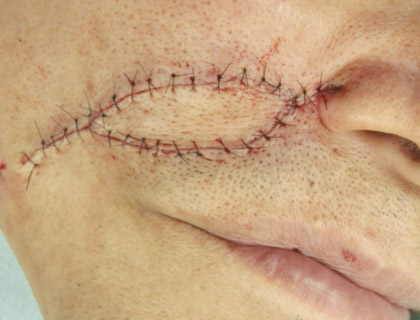 頬部皮膚悪性腫瘍：手術終了直後