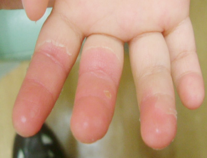 手指熱傷（やや深めのヤケド）：受傷12日目