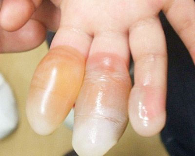 手指熱傷（やや深めのヤケド）：初診時（受傷後1日目）