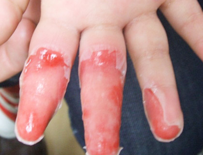 手指熱傷（やや深めのヤケド）：初診時（水泡膜除去後）